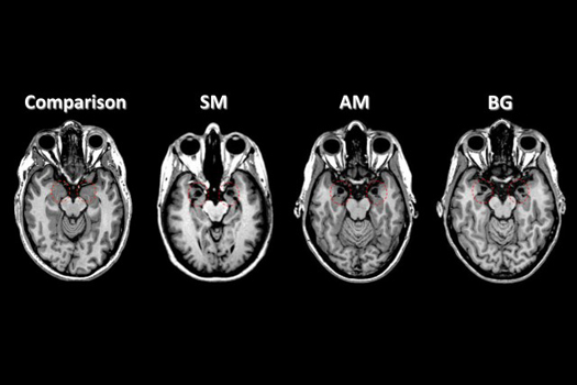 Researchers Scare The Crap Out Of Patients Who Supposedly Can’t Feel Fear