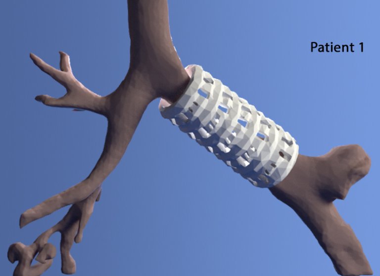 3D-Printed Biomaterial Restores Babies’ Breathing