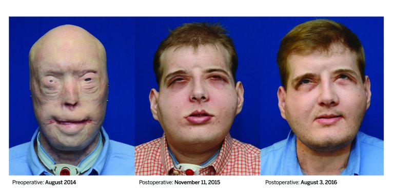 One Year Later, Face Transplant Recipient Just A Normal Guy