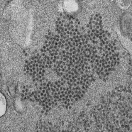 What we know about the polio-like illness paralyzing children—and what we don’t
