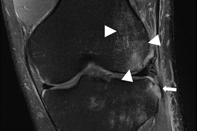 AI knee