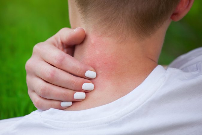 Person with blond hair and white nail polish scratching mosquito bites that could carry viruses